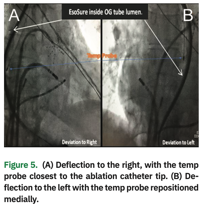 Mechanical Deviation of the Esophagus During Atrial Fibrillation